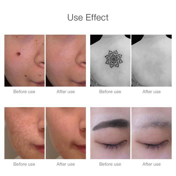 Appareil d'enlèvement de tatouage permanent au laser portable